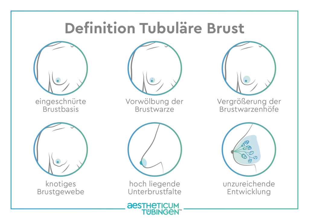 Grafik Definition Tubuläre Brust