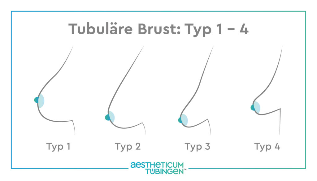 Grafik Tubuläre Brust Typ 1–4