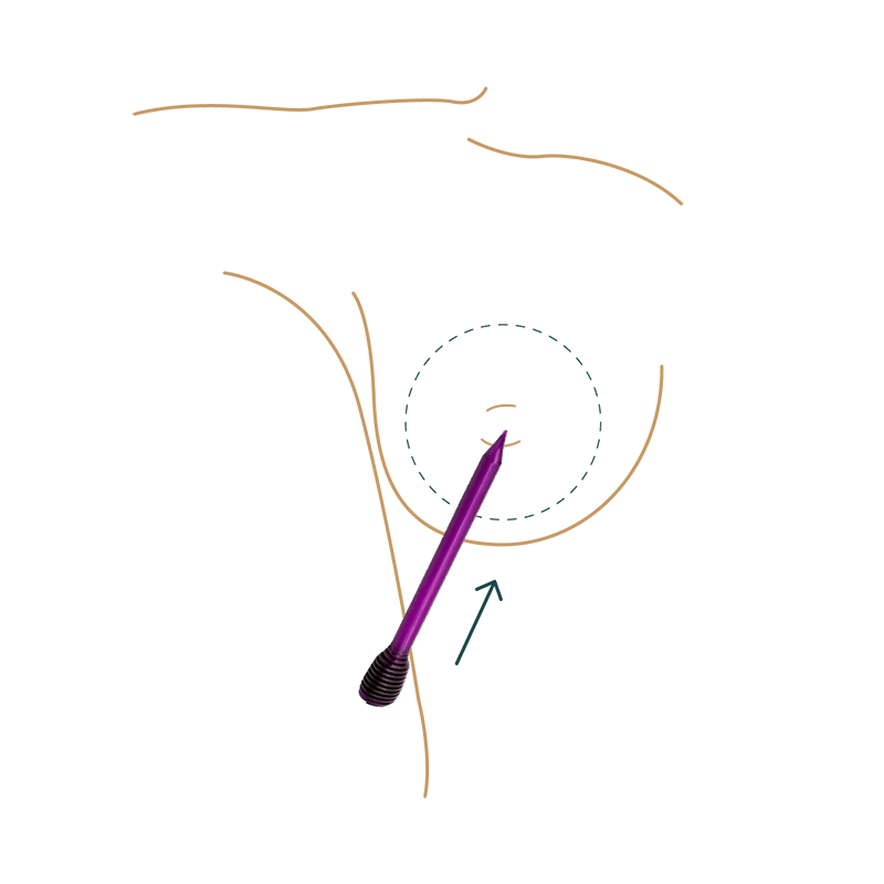 Implantattasche