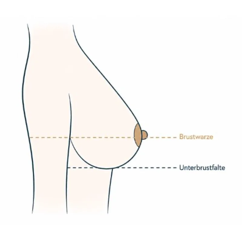 Pseudoptosis: Illustration – Brustwarze oberhalb der Unterbrustfalte, Brustgewebe im unteren Pol abgesunken