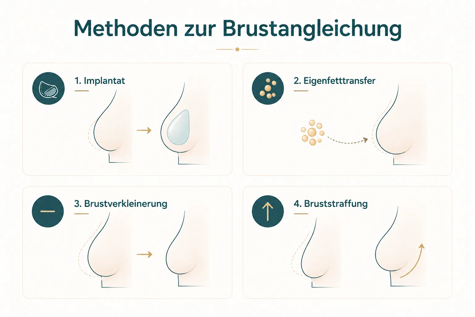 Infografik: Vier Methoden zur Brustangleichung bei Anisomastie – Implantat, Eigenfetttransfer, Brustverkleinerung und Bruststraffung