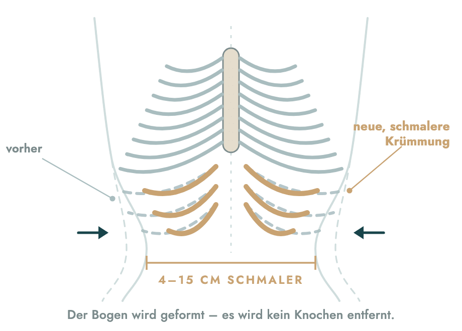 Der untere Rippenbogen wird nach innen in eine schmalere Kr&uuml;mmung gebracht