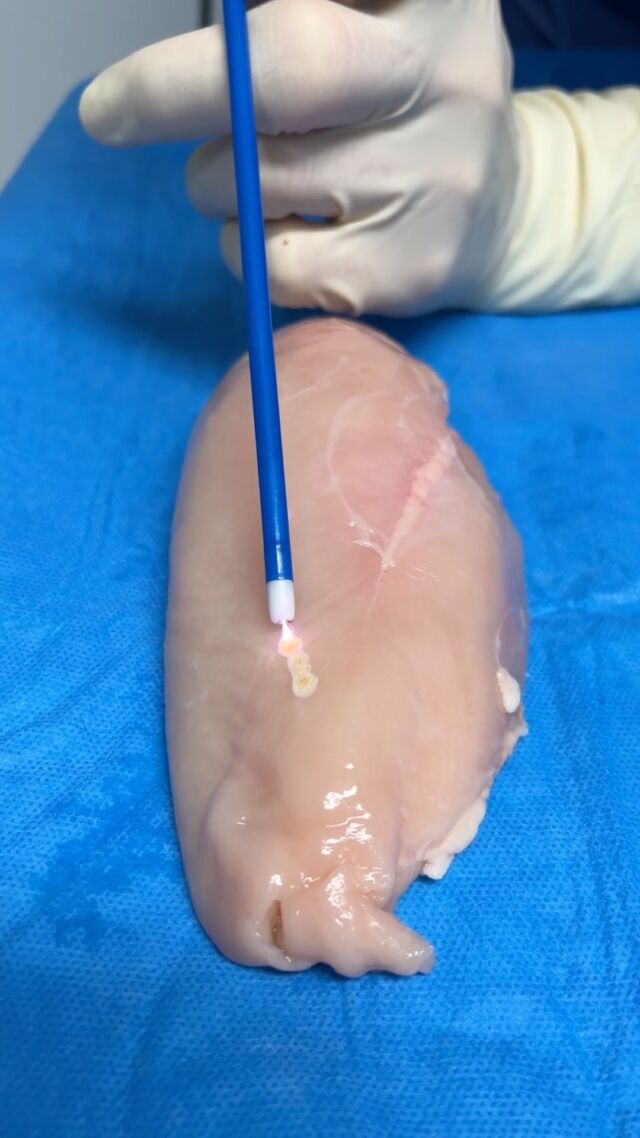 Wusstet ihr, dass man Hautstraffungen auch ohne die chirurgische Entfernung von Gewebe durchführen kann?! Mit der innovativen und gewebeschonenden Argon Plasma Straffung - hier am Beispiel einer Hühnerbrust zu sehen - erzielen wir erstaunliche Ergebnisse! Stay tuned for more!

#aestheticumtübingen #tübingen #plastischechirurgie #ästhetischechirurgie #reutlingen #stuttgart #beratung #liposuktion #argonplasma #hautstraffung #fettabsaugung #faltenstraffung