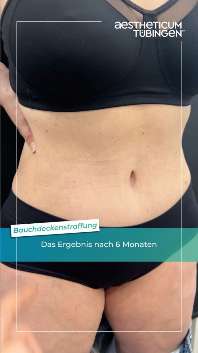 Hier seht ihr das gelungene Ergebnis einer Bauchdeckenstraffung. Die 64-jährige Patientin war 6 Monate nach dem Eingriff bei mir zur Kontrolle.

Durchgeführt wurde eine High-Tension Abdominoplastik, bei der 1,6 Kg Bauch- und Hautgewebe, sowie 4300 ml reines Fett abgesaugt wurden. Entfernt wurde dies vor allem an der Taille, im Übergang zu den Reiterhosen und am Schamhügel.

Mit diesem gelungenen Eingriff konnte ich der Patientin zu einem komplett neuen Lebensgefühl verhelfen - wir freuen uns beide riesig! Der Sommer kann kommen!

#aestheticumtübingen #tübingen #plastischechirurgie #ästhetischechirurgie #reutlingen #stuttgart #beratung #drphilippbraun #droliverlotter #martinpham #op #arbeitsalltag #plastischerchirurg #klinik #bauchdeckenstraffung #hightensionlipo #liposuktion #fettabsaugung #contouring