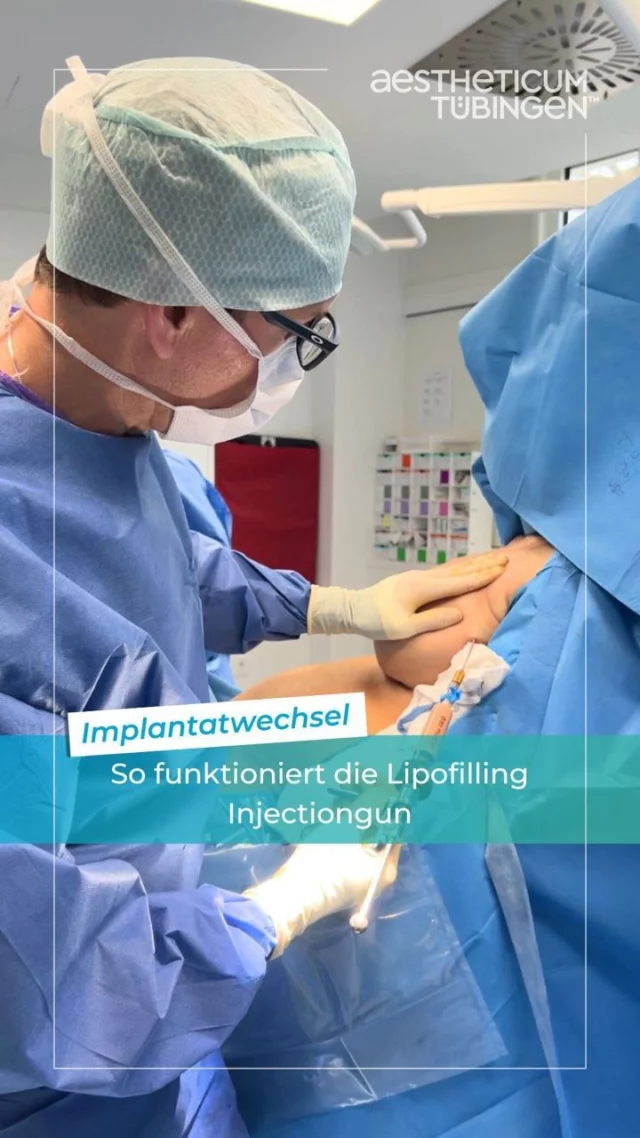 Bei dieser Patientin habe ich einen Implantatwechsel aufgrund einer Implantatruptur durchgeführt. In Zuge dessen hat sich die Patientin den Einsatz von größeren Implantaten gewünscht. 

Um einen natürlichen Look zu schaffen, kam die Lipofilling-Injectiongun zum Einsatz. Hierbei werden Fett-Depots in den oberen Pol der Brust und den Dekolleté-Bereich gespritzt. 

Für weitere Informationen zum Thema Brustvergrößerung, bieten wir auf unserer Website zahlreiche Blogbeiträge an. 😊

#aestheticumtübingen #tübingen #plastischechirurgie #ästhetischechirurgie #reutlingen #stuttgart #beratung #drphilippbraun #droliverlotter #martinpham #op #arbeitsalltag #plastischerchirurg #klinik #brustvergrößerung #implantat #lipofilling #dekolleté #brustop