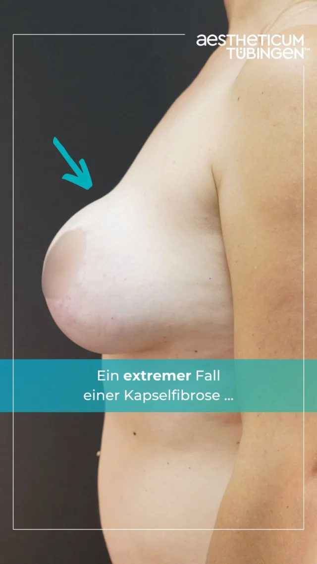 Hier sehen wir einen sehr ausgeprägten Fall einer Kapselfibrose! 😳

Da es sich hier um eine medizinische Indikation handelt, dürfen wir euch Vorher-Nachher-Bilder zeigen.

Die Patientin litt viele Jahre unter starken Schmerzen und Einschränkungen. Dies führte unteranderem auch zu einer gewissen Angst vor einer zweiten Operation. Nach einem intensiven Beratungsgespräch hat sich die Patientin für eine Implantat-Entfernung mit einer anschließenden Eigenfett-Transplantation entschieden.
Zuvor hatte die Patientin Implantate mit einem Volumen von 380 ml in der rechten Brust und 400 ml in der linken Brust. Nach der Entfernung der Implantate wurden 250 ml Eigenfett in die rechte Brust und 200 ml in die linke Brust transplantiert.

Heute ist die Patientin nicht nur schmerzfrei, sondern auch sehr zufrieden, sowie ich auch! 🙌🏼

#kapselfibrose #implant #implantate #brustvergrößerung #brustverkleinerung #brustop #brustoperation #eigenfett #eigenfetttransplantatioin #aestheticumtuebingen #drphilippbraun #tübingen #stuttgart #münchen #reutlingen #berlin #metzingen