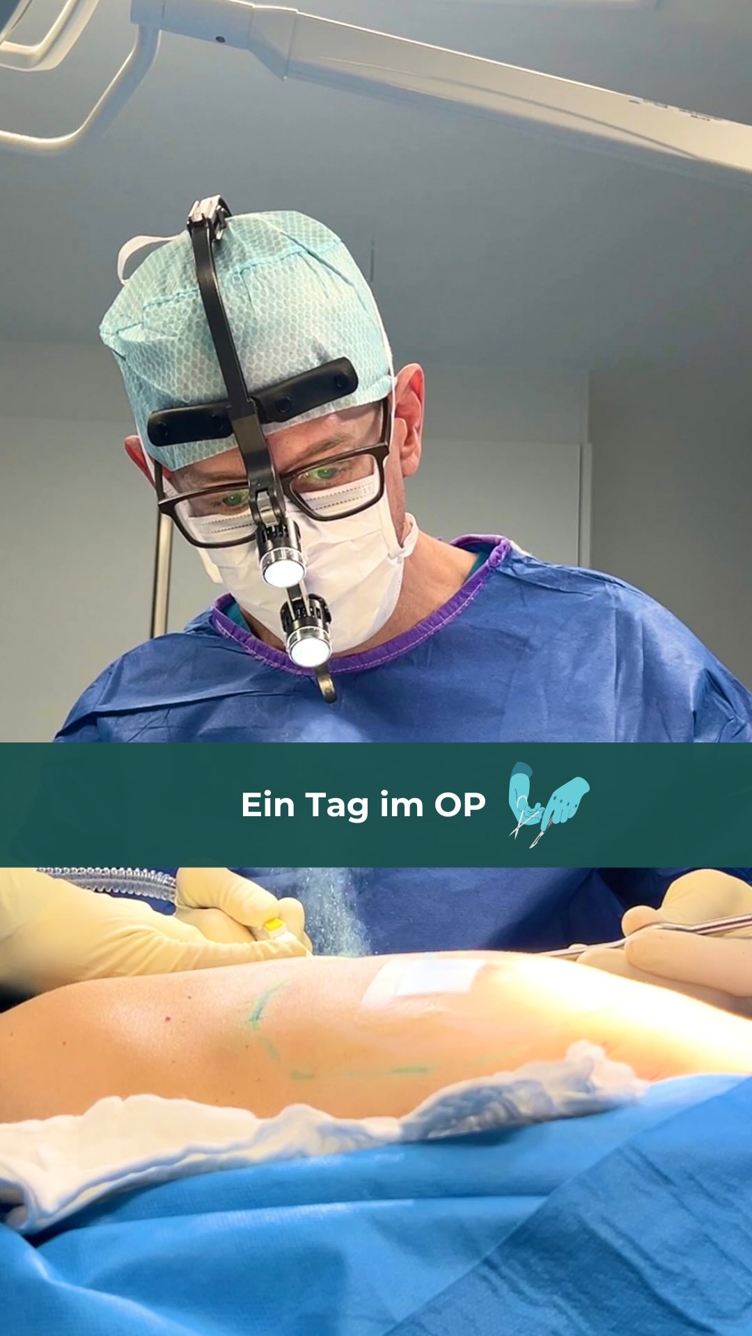 ✨Ein Blick hinter die Kulissen: Brustvergrößerung ✨

Schritt für Schritt nehme ich euch heute mit, bei einer OP!

Vom anzeichnen bis hin zur Naht, jeder Schritt erfolgt mit höchster Präzision.🧑🏻‍⚕️ Es ist jedes Mal faszinierend zu sehen, wie aus einer Vision eine Veränderung entsteht, die mehr Selbstbewusstsein und Zufriedenheit schenkt!😊✨

Bei welcher OP sollen wir euch als nächstes mitnehmen?👀
-
-
-
-
-
-
-
-
-
#plastischechirurgie #plasticsurgery #plastischechirurgen #plasticsurgeons #plastischechirurgiestuttgart #brustvergrößerung #brustvergrösserung #brustvergrößerungstuttgart #aestheticumtuebingen #aestheticumtübingen