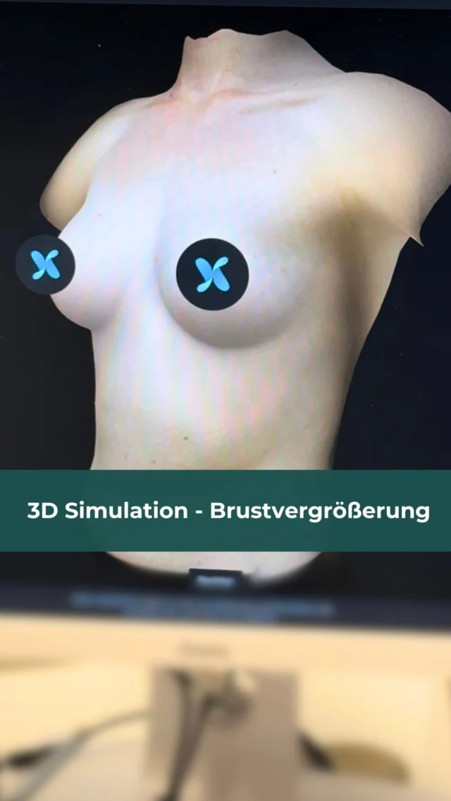 Mögliches Ergebnis schon VOR der OP sehen?😮

Mit unserer 3D Simulation ist genau das möglich!🎉 Diese innovative Technologie hilft und eure Wünsche genau zu verstehen und gemeinsam das für euch perfekte Ergebnis zu planen!✨

Buche jetzt deinen individuellen Beratungstermin📅: Link in der Bio!🔗
-
-
-
-
-
-
-
-
-
#aesthetic #plasticsurgery #plasticsurgeon #plastischechirurgie #plastischechirurgiestuttgart #medizin #medicine #aestheticumtübingen #aestheticumtuebingen