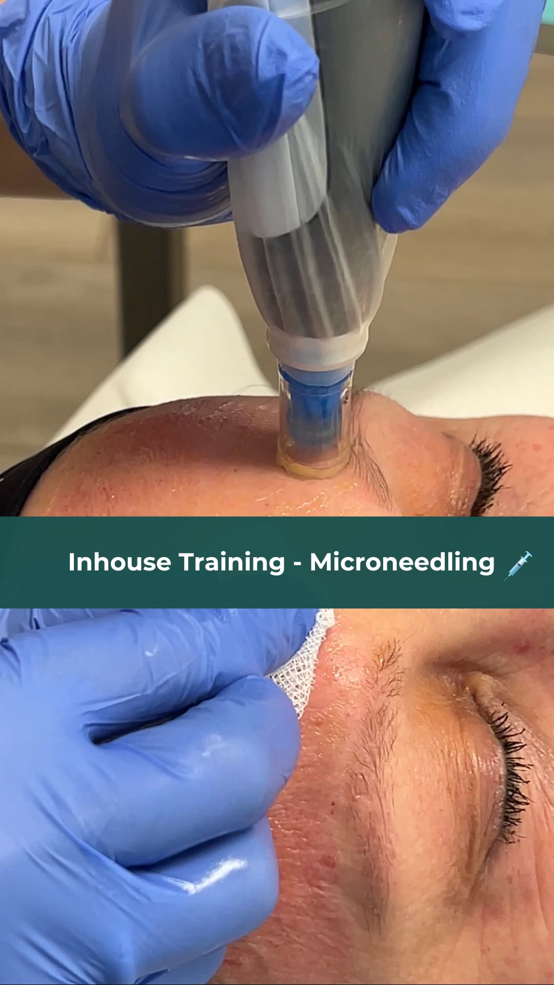 🌟 Weiterbildung auf höchstem Niveau! 🌟

Wir legen  großen Wert auf kontinuierliche Schulungen, um für euch, unsere Patienten, weiterhin die besten Ergebnisse zu erzielen.✨ 

Das aktuelle Thema unseres Inhouse Trainings: Microneedling!💉👀

Micorneedling ist eine effektive Methode zur Verbesserung von Hautstruktur und -elastizität, zur Reduzierung von Narben und Falten sowie zur Förderung der Kollagenproduktion. 🧖‍♀️💖

Es tut auch deutlich weniger weh, als man denkt!😁🩹
-
-
-
-
-
-
-
-
#microneedling #microneedlingstuttgart #microneedlingtübingen #medizin #medicine #plasticsurgery #plasticsurgeons #plastischechirurgie #aestheticumtübingen #aestheticumtuebingen