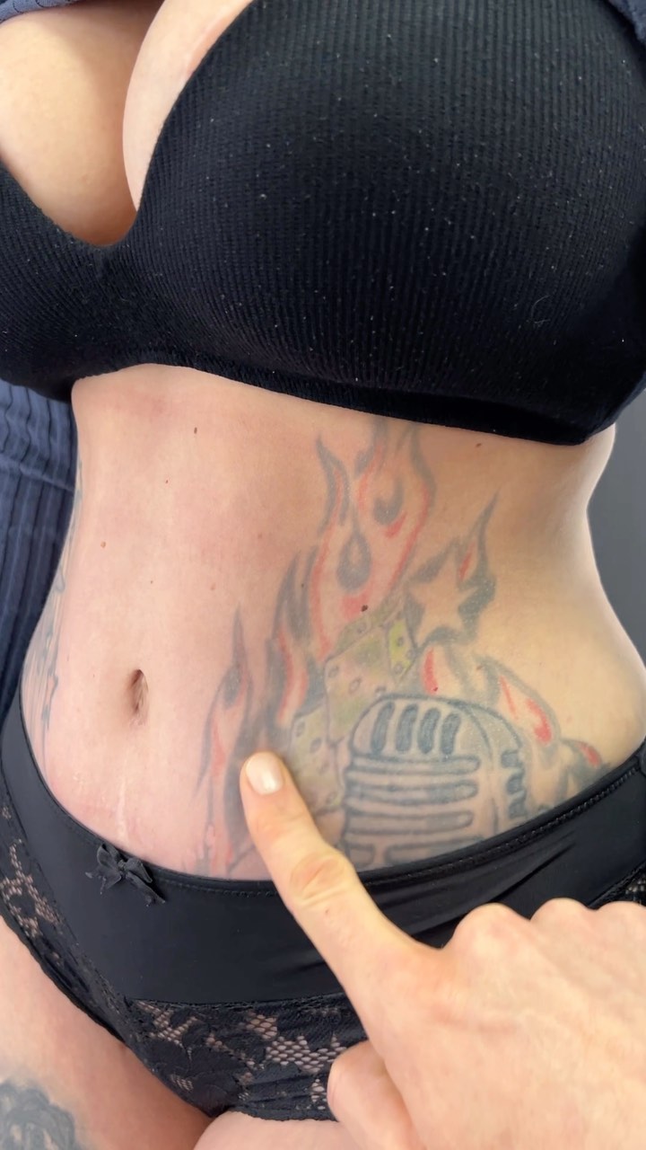 Einfach nur Hammer:
Ergebnis 2 Monate nach einer Bauchdeckenstraffung mit High Definition Liposuktion.
Wir haben uns wie im Video zu hören beide sehr über das Ergebnis gefreut…
 Danke das ich die Fotos hier zeigen durfte 🙏

#tübingen#tuebingen#reutlingen#rottenburg#herrenberg#mössingen#hechingen#horb#nagold#sindelfinden#böblingen#filderstadt#nürtingen#badurach#albstadt#stuttgart#ulm#freudenstadt#nürtingen#bauchdeckenstraffung#liposuction#abdominoplasty#higdefinitionlipo#bauchop#mommymakeover