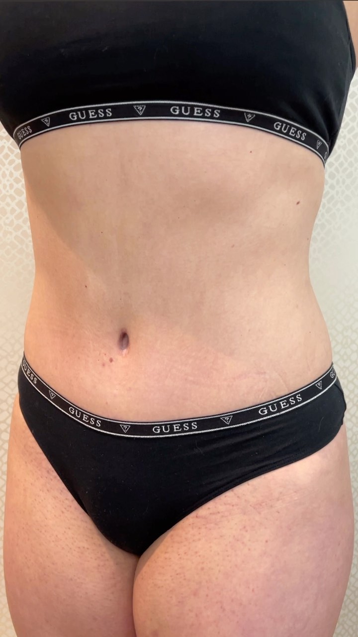 Und noch ein Ergebnis nach einer high Definition Lipoabdominoplastik …
Die Patientin muss immer noch regelmäßig vor Glück weinen wenn sie in den Spiegel schaut…
Die unglaubliche Freude und die große Dankbarkeit über ihr Ergebnis haben mich heute tief gerührt… deswegen gibts heute mal zwei Posts an einem Tag…😂
Schönes Wochenende 

#tübingen#stuttgart#mannheim#karlsruhe#freiburg#heidelberg#heilbronn#ulm#pforzheim#reutlingen#augsburg#esslingen#ludwigsburg#tuebingen#villingen-schwenningen#konstanz#aalen#sindelfingen#schwäbischgmünd#friedrichshafen#offenburg#göppingen#waiblingen#badenbaden#ravensburg#rastatt#böblingen#heidenheim