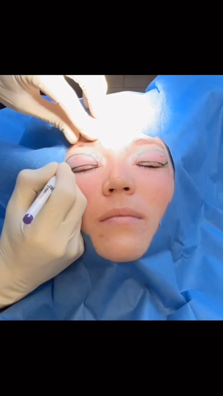 Hier zeigen wir euch mal den Ablauf einer Lidstraffung