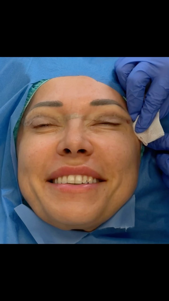 Oberlidstraffung im Zeitraffer…
Absolut eine meiner Lieblings OPs.