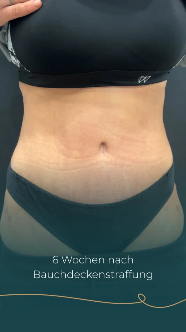 Hier sieht man ein sehr schönes Ergebnis sechs Wochen nach einer Bauchdeckenstraffung mit einer Rekonstruktion der Rectusmuskulatur. Insgesamt wurden ca 1.000 Gramm Gewebe sowie 1,3 Liter Fett entfernt.

Zusätzlich erfolgte eine dezente Definition der Mittellinie und der paramedialen Linien mittels Fettabsaugung, ebenso an den Flanken, am Schamhügel und im Bereich der Subrahip-Dips.

Ich freue mich sehr über dieses harmonische Ergebnis und die positive Entwicklung im Heilungsverlauf.

Be confident. Be you.

#Bauchdeckenstraffung #Ergebnis
#AestheticumTübingen #Tübingen
